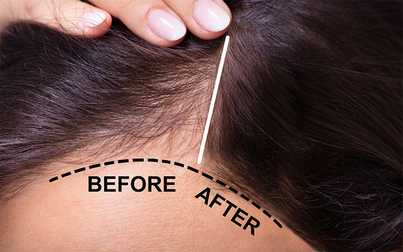 Hair Loss Treatment