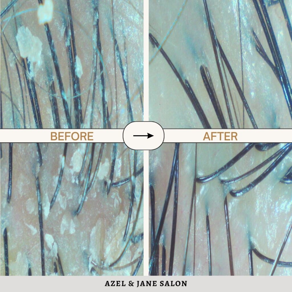 The Benefits of Doing a Dandruff Treatment